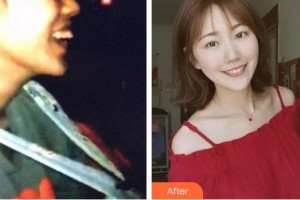 福州東南口腔醫(yī)院王凌云整形價格表附隱形托槽矯正案例展示