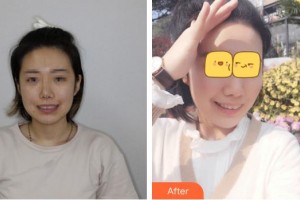 福州同福醫(yī)口腔門診部何鐘強(qiáng)整形價格表附瓷貼面日記案例展示