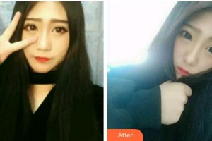 福州維樂口腔門診部林錦整形價(jià)格表附牙齒隱形矯正案例展示