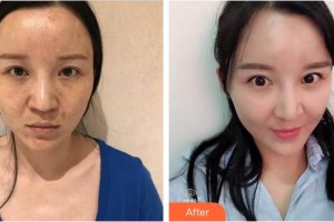 廈門華美名媛整形美容醫(yī)院李平珍整形價(jià)格表附自體脂肪面部填充案例展示