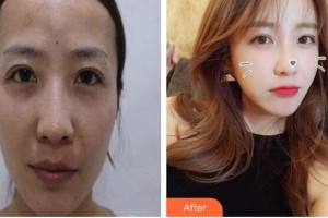 廈門華美名媛整形美容醫(yī)院梁春花整形價(jià)格表附自體脂肪全臉填充案例展示