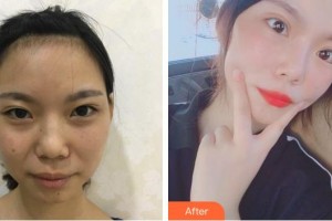 廈門蘭的整形外科門診部張玉娟整形價(jià)格表附埋線雙眼皮+去脂案例展示