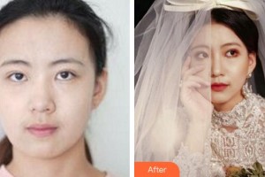 廈門海峽整形美容醫(yī)院賴炳招整形價格表附熱瑪吉案例展示