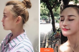 廈門海峽整形美容醫(yī)院童晉文整形價格表附肋軟骨隆鼻案例展示