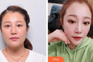 廈門大學(xué)附屬東南醫(yī)院燒傷整形科陳錦河整形價格表附埋線雙眼皮+去脂案例展示