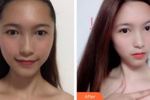 廈門海峽整形美容醫(yī)院張宏整形價格表附洛麗塔眼部手術(shù)案例展示