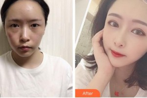 廈門莫琳娜醫(yī)療美容門診部陳石海整形價格表附新月桃花眼部手術(shù)案例展示
