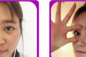 廈門華美名媛整形美容醫(yī)院謝常禮整形價格表附鼻部整形案例展示