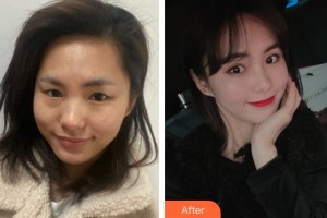 廈門張銘整醫(yī)療美容診所林潮整形價格表附眼部綜合案例展示