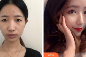 廈門張銘整醫(yī)療美容診所陳明整形價格表附眼部整形案例展示
