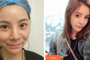 廈門市第一醫(yī)院思明分院整形外科許春鵬整形價(jià)格表附鼻部多項(xiàng) 日式自然鼻案例展示