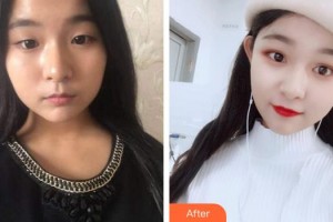 王根治整形價(jià)格表附爽妹子爽的鼻部手術(shù)案例展示