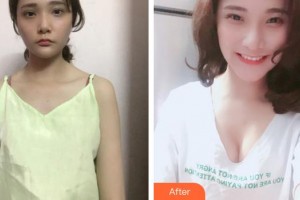 廈門莫琳娜醫(yī)療美容門診部葉佐誠(chéng)整形價(jià)格表附豐胸案例展示
