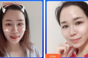 廈門大學(xué)附屬?gòu)B門眼科中心醫(yī)院劉旭陽(yáng)整形價(jià)格表附5S重瞼術(shù)+超微創(chuàng)開內(nèi)眥案例展示