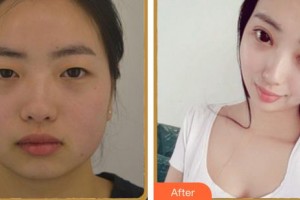 廈門大學(xué)附屬?gòu)B門眼科中心醫(yī)院毛祖紅整形價(jià)格表附眼部多項(xiàng)案例展示