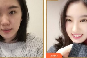 廈門(mén)大學(xué)附屬?gòu)B門(mén)眼科中心醫(yī)院李孟瓊整形價(jià)格表附眼部綜合案例展示