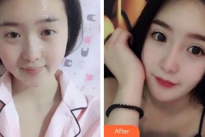 廈門(mén)大學(xué)附屬?gòu)B門(mén)眼科中心醫(yī)院周山整形價(jià)格表附眼部綜合案例展示