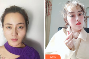 廣州廣大整形美容醫(yī)院于曉強整形價格表附顴骨顴弓整形術(shù)	案例展示