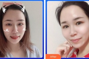 廈門(mén)大學(xué)附屬?gòu)B門(mén)眼科中心醫(yī)院李東侃整形價(jià)格表附眼部案例展示