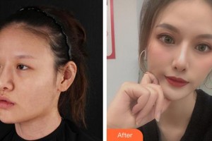 廈門(mén)大學(xué)附屬?gòu)B門(mén)眼科中心醫(yī)院徐靜靜整形價(jià)格表附眼部案例展示