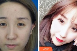 廈門(mén)大學(xué)附屬?gòu)B門(mén)眼科中心醫(yī)院歐陽(yáng)文博整形價(jià)格表附切開(kāi)雙眼皮案例案例展示