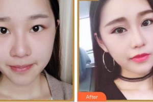 廈門(mén)大學(xué)附屬?gòu)B門(mén)眼科中心醫(yī)院范巍整形價(jià)格表附眼部綜合案例展示