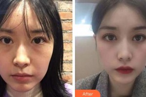廈門(mén)大學(xué)附屬?gòu)B門(mén)眼科中心醫(yī)院董諾整形價(jià)格表附眼部案例展示