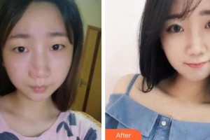 廈門(mén)大學(xué)附屬?gòu)B門(mén)眼科中心醫(yī)院葉梅整形價(jià)格表附自然雙眼皮案例展示