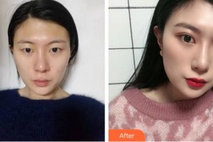 廈門(mén)大學(xué)附屬?gòu)B門(mén)眼科中心醫(yī)院付彥敏整形價(jià)格表附眼部手術(shù)案例展示