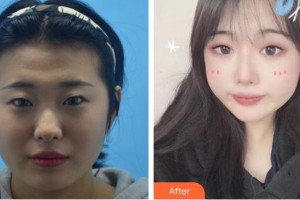 廈門(mén)大學(xué)附屬?gòu)B門(mén)眼科中心醫(yī)院羅順榮整形價(jià)格表附眼部手術(shù)案例展示