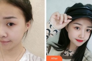 廈門(mén)大學(xué)附屬?gòu)B門(mén)眼科中心醫(yī)院莊建福整形價(jià)格表附眼部手術(shù)案例展示