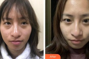 廈門(mén)大學(xué)附屬?gòu)B門(mén)眼科中心醫(yī)院修陽(yáng)暉整形價(jià)格表附不開(kāi)刀去眼袋+淚溝填充案例展示