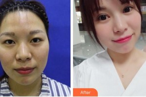 廈門(mén)大學(xué)附屬?gòu)B門(mén)眼科中心醫(yī)院陳雙成整形價(jià)格表附全切雙眼皮案例展示