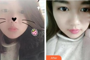廈門(mén)大學(xué)附屬?gòu)B門(mén)眼科中心醫(yī)院楊美瓊整形價(jià)格表附眼部手術(shù)案例展示