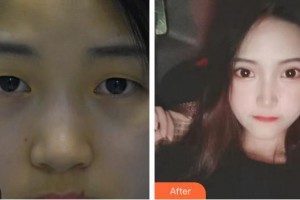 廈門(mén)大學(xué)附屬?gòu)B門(mén)眼科中心醫(yī)院陳文生整形價(jià)格表附眼部手術(shù)案例展示