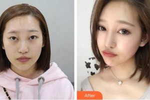 廈門(mén)大學(xué)附屬?gòu)B門(mén)眼科中心醫(yī)院何歡整形價(jià)格表附變身大眼“氣質(zhì)女孩”案例展示