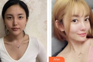 廈門(mén)大學(xué)附屬?gòu)B門(mén)眼科中心醫(yī)院楊梅整形價(jià)格表附眼部手術(shù)案例展示