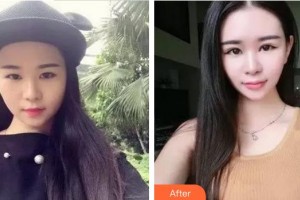 廈門(mén)大學(xué)附屬?gòu)B門(mén)眼科中心醫(yī)院沈政偉整形價(jià)格表附雙眼皮修復(fù)快三個(gè)月案例展示