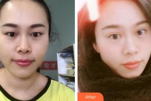 廈門(mén)大學(xué)附屬?gòu)B門(mén)眼科中心醫(yī)院王海燕整形價(jià)格表附眼部手術(shù)案例展示