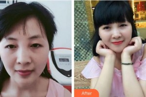 廈門(mén)大學(xué)附屬?gòu)B門(mén)眼科中心醫(yī)院揭黎明整形價(jià)格表附雙眼皮案例展示
