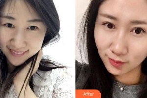 廈門(mén)大學(xué)附屬?gòu)B門(mén)眼科中心醫(yī)院胡繼發(fā)整形價(jià)格表附眼部綜合案例展示