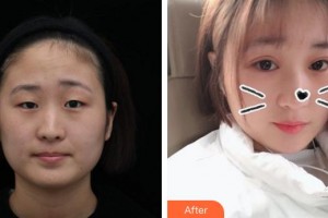 廈門市海滄醫(yī)院眼科張萌整形價格表附眼部手術(shù)案例展示