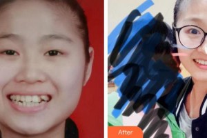 廈門醫(yī)學院附屬口腔醫(yī)院李水根整形價格表附牙齒矯正案例展示