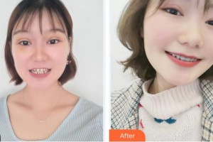廈門(mén)鉑菲特口腔門(mén)診部劉保留整形價(jià)格表附牙齒矯正案例展示