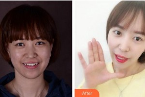 廈門(mén)鉑菲特口腔門(mén)診部王鈺姬整形價(jià)格表附隱形矯正案例展示