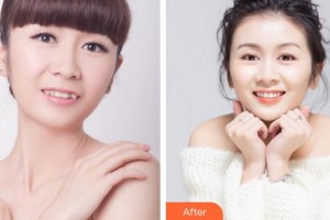廈門(mén)峰煜口腔門(mén)診部沈賢生整形價(jià)格表附隱形托槽矯正案例展示