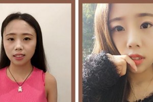 廈門(mén)現(xiàn)代口腔門(mén)診部任祥保整形價(jià)格表附隱形牙齒矯正案例展示