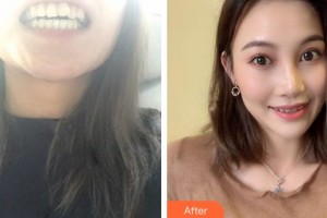 廈門(mén)麥芽口腔醫(yī)院姚江武整形價(jià)格表附半隱形矯正案例展示