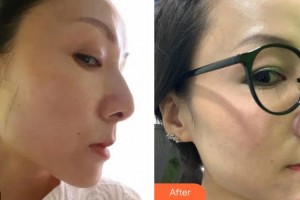 莆田海峽整形美容醫(yī)院陳藝整形價(jià)格表附埋線(xiàn)提升案例展示