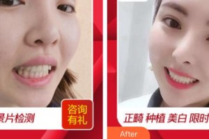 莆田群益口腔門(mén)診部劉宗錦整形價(jià)格表附牙齒做美容案例展示